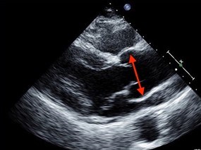 Echocardiogram demonstrating an aortic root aneurysm